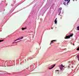 Microscopic image showing heart tissue with white blood cells, indicating trauma.