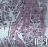 Microscopic image showing human heart tissue with white blood cells present.